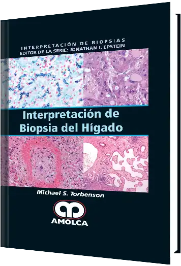 Interpretación de Biopsia del Hígado