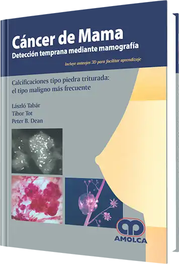 Cáncer de Mama Detección Temprana Mediante Mamografía