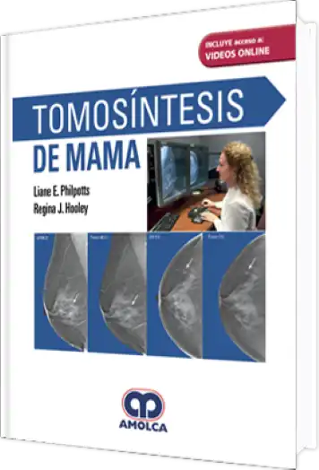 Tomosíntesis de Mama